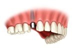 Wszczepienie implanta zębowego