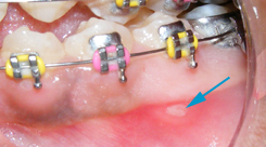 Uraz jamy ustnej a aparat ortodontyczny