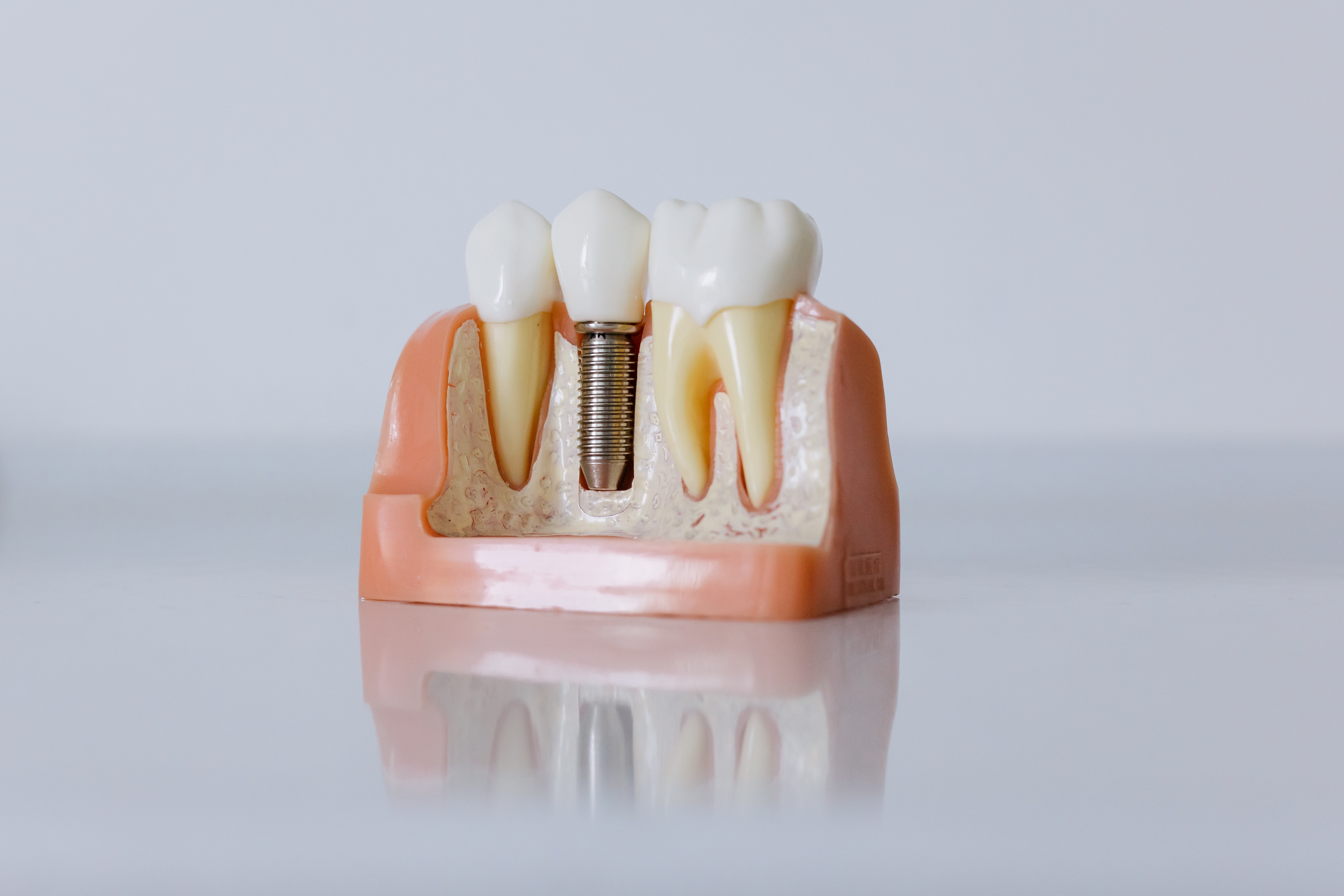 Jaka jest żywotność implantów zębowych