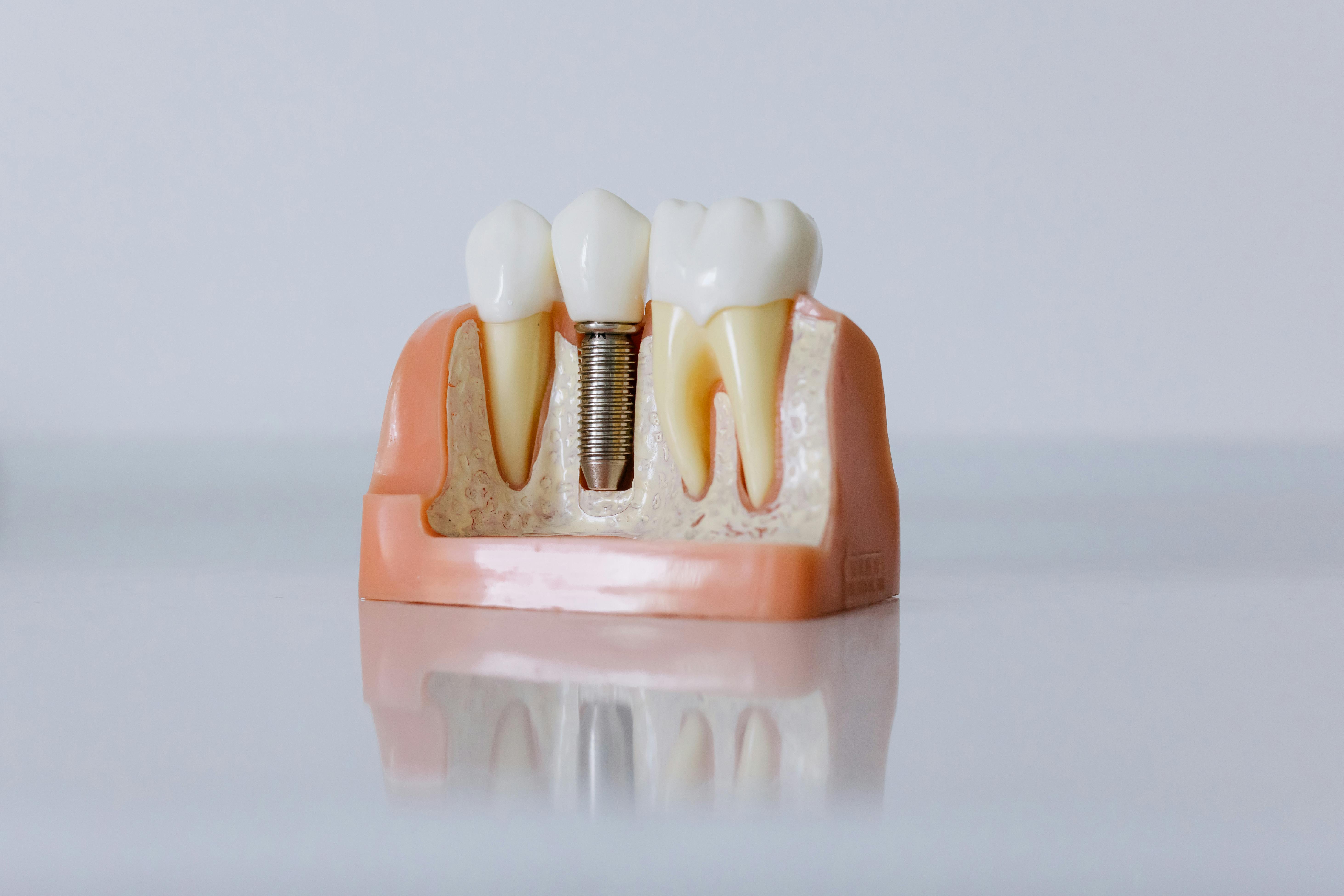 Jak wygląda zabieg zakładania implantów stomatologicznych?