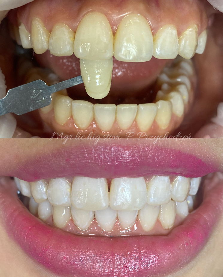 Laserowe wybielanie zębów Warszawa - zdjęcie przed i po
